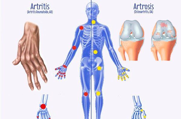 Diferencias Entre La Artrosis La Artritis Y La Osteoporosis Stop En Línea